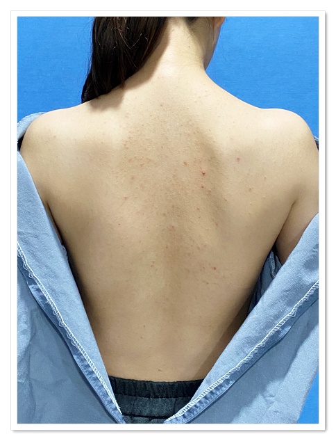구미등여드름치료 전 화농성 여드름과 색소침착이 있는 등 상태