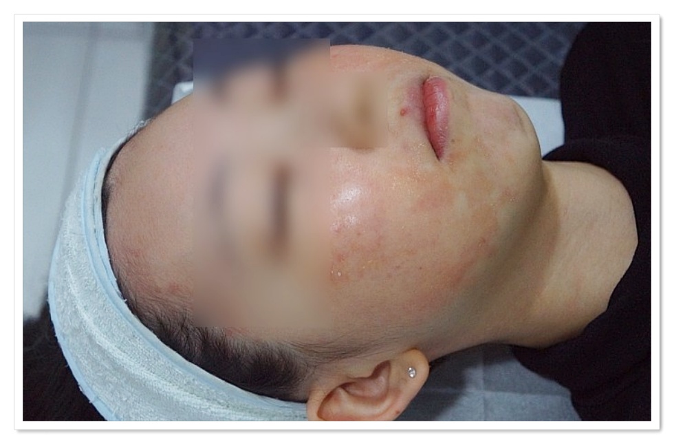 구미지루성피부염치료 전 얼굴 홍조와 농포가 있는 상태