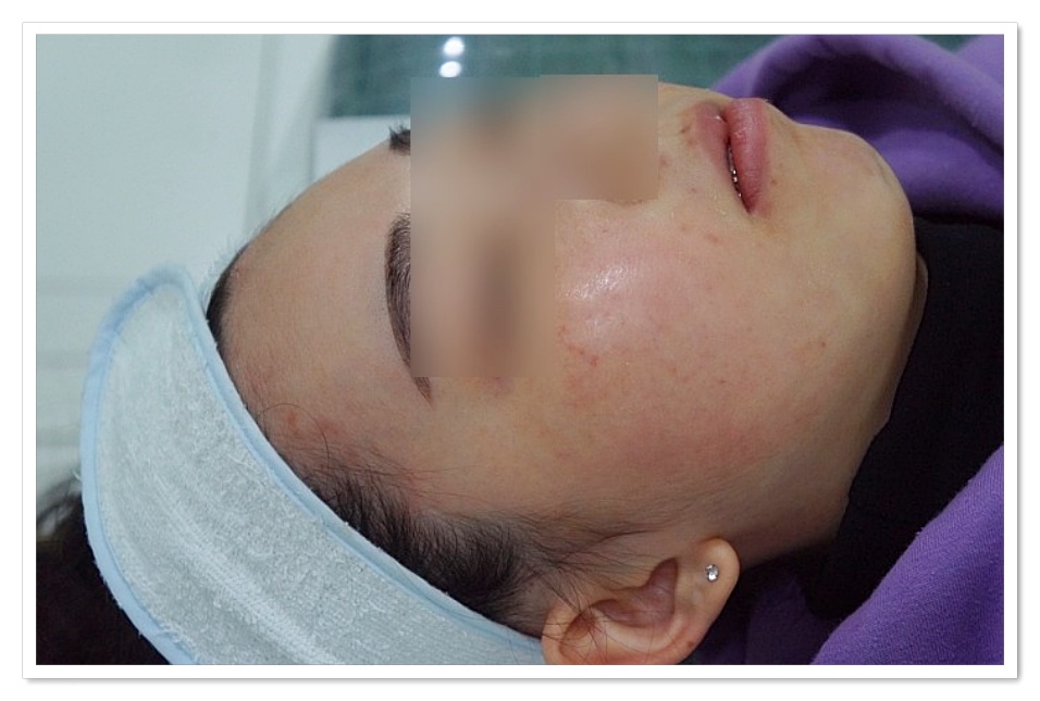 구미지루성피부염치료 한약 복용 2주차 시술 1회 후 얼굴 상태