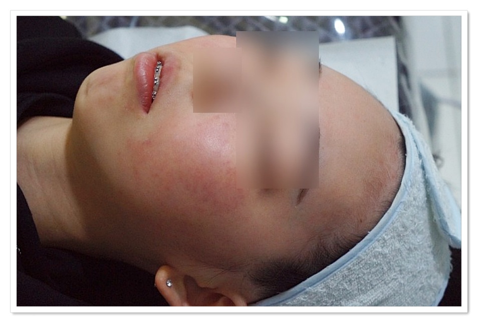 구미지루성피부염치료 4주차 피지 분비 줄어든 피부 상태