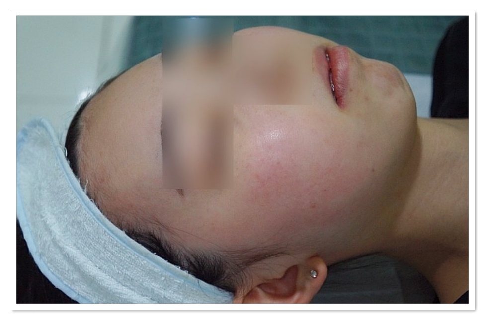 구미지루성피부염치료 붉은기가 완화된 상태