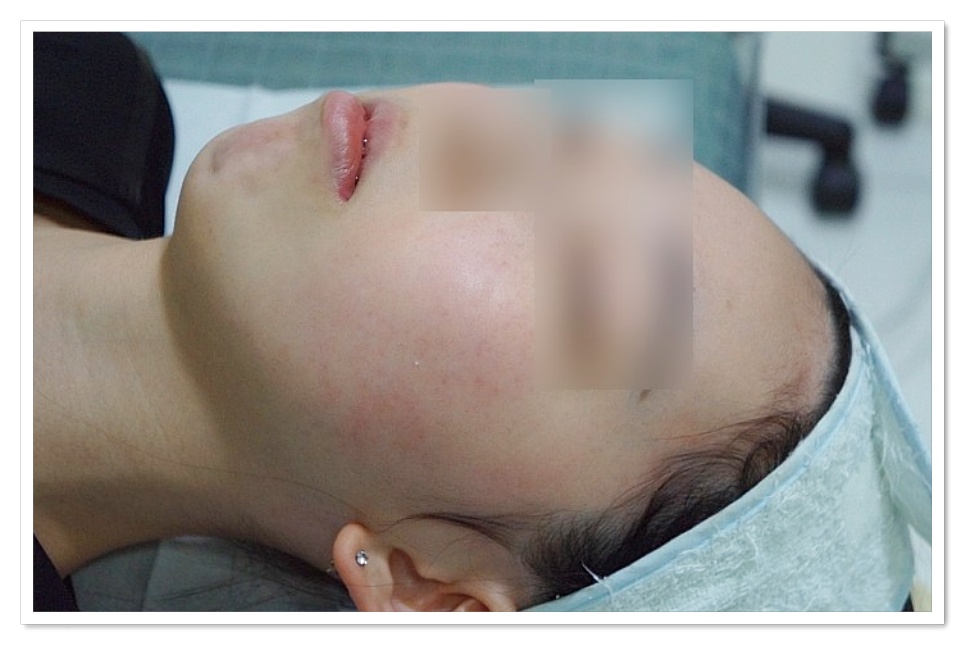 구미지루성피부염치료 붉은기가 완화된 상태