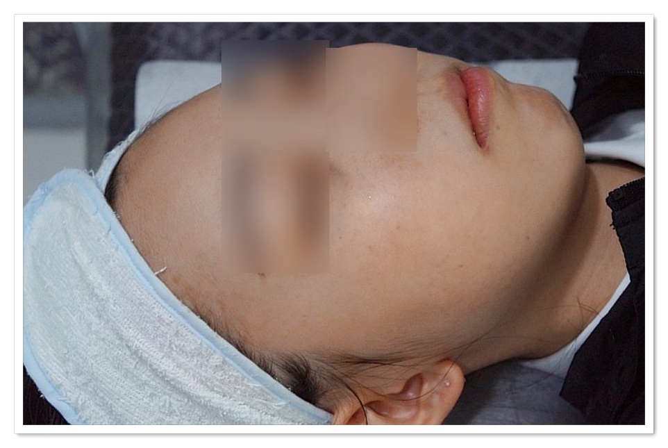 구미지루성피부염치료 홍조가 사라진 얼굴 사진
