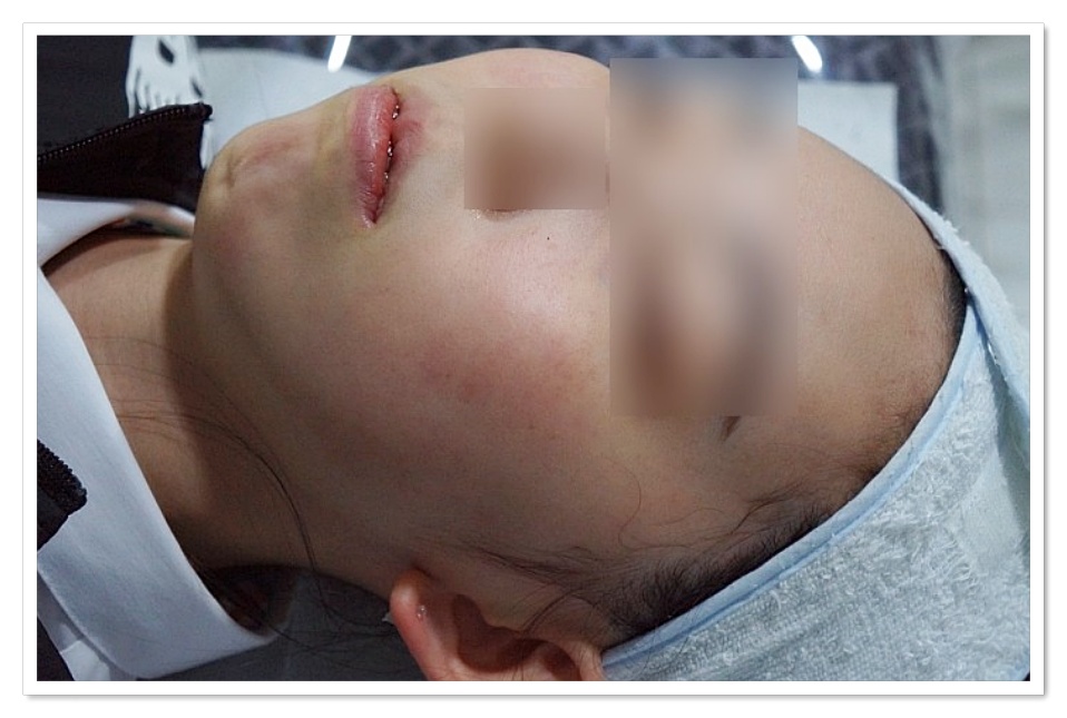 구미지루성피부염치료 염증과 붉은기가 사라진 상태