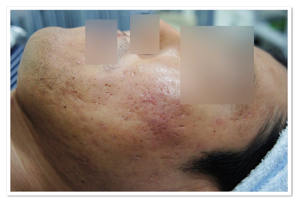구미새살침 1회 시술 후 거리 두고 본 피부 상태