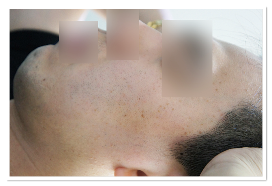 구미편평사마귀치료 전 좌측 얼굴 관자놀이 상태