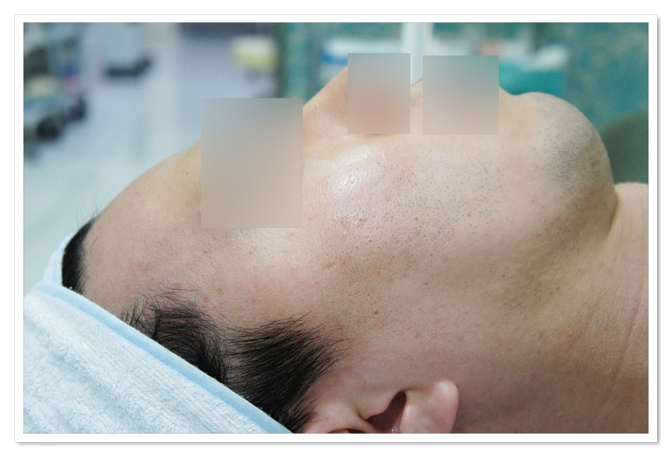 구미편평사마귀치료 3주일 후 재생 완료된 우측 얼굴