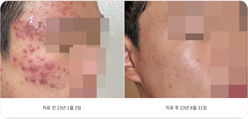 구미여드름한의원 화농성 병변 치료 전후 비교 사진