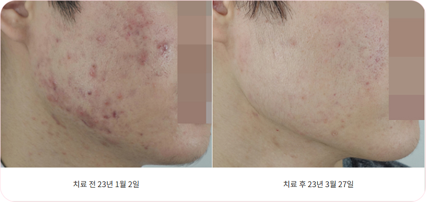 구미여드름한의원 볼 부분 퍼져 있는 여드름 치료 전후 비교