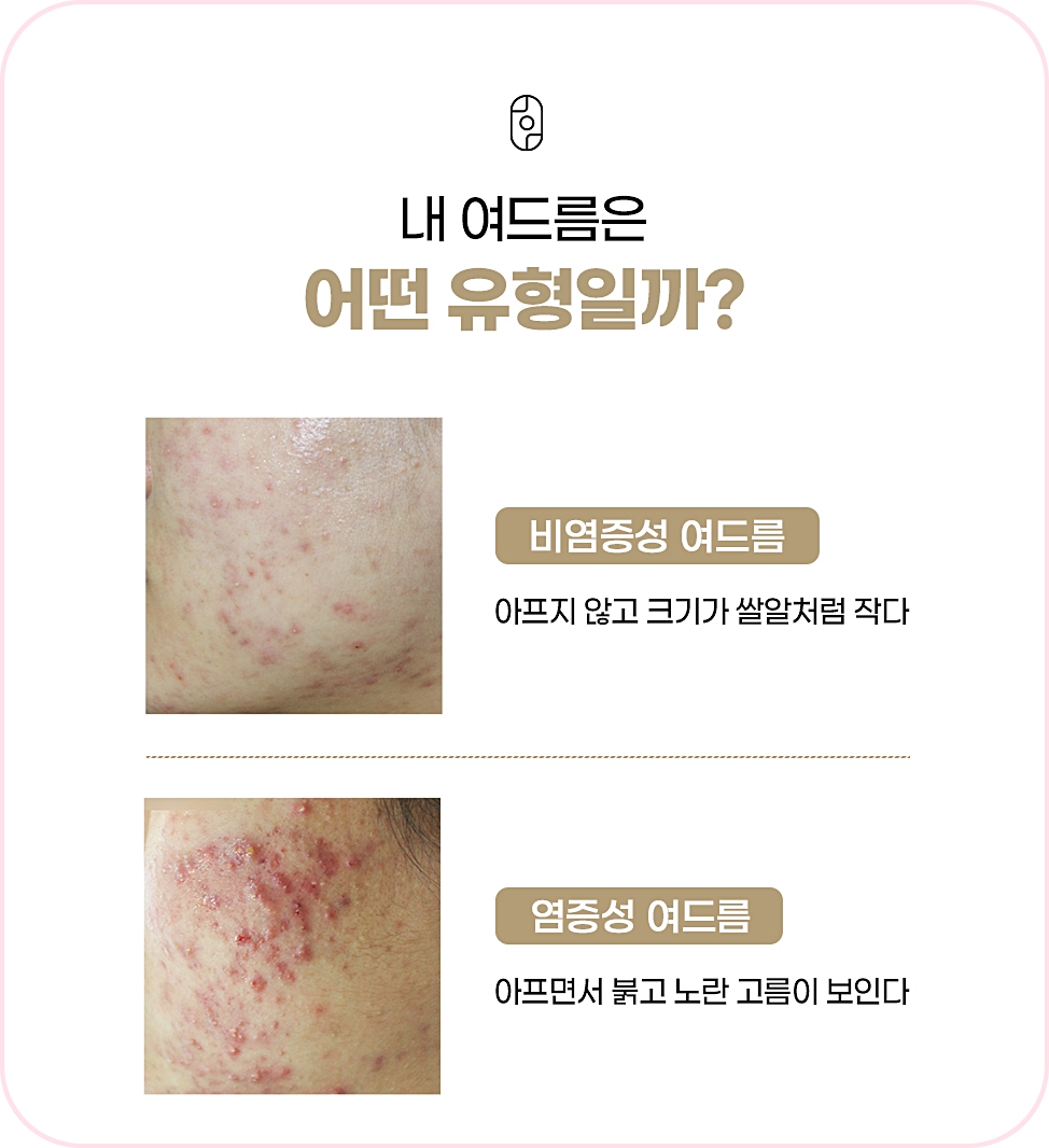 여드름의 다양한 유형 설명하는 이미지