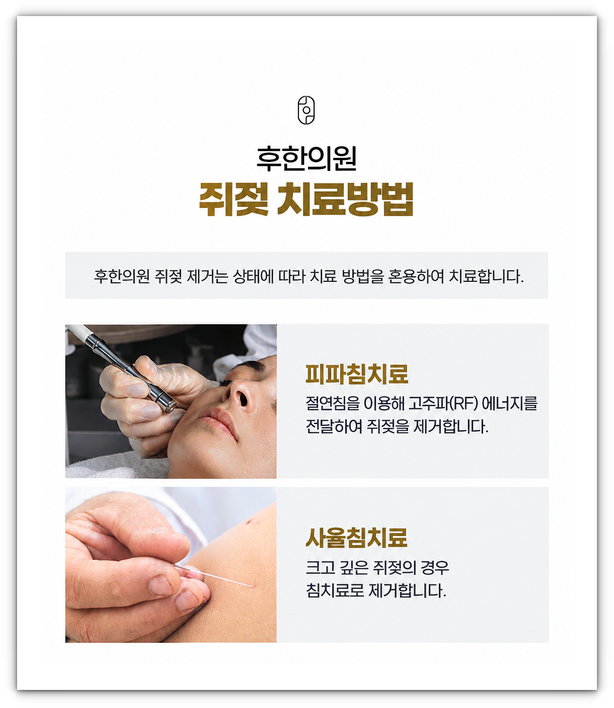 구미쥐젖제거 한의원의 쥐젖 치료 방법 두 가지 소개