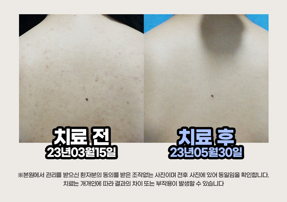 등가슴여드름 치료 전후 등 피부 비교, 2023년 3월과 5월 촬영