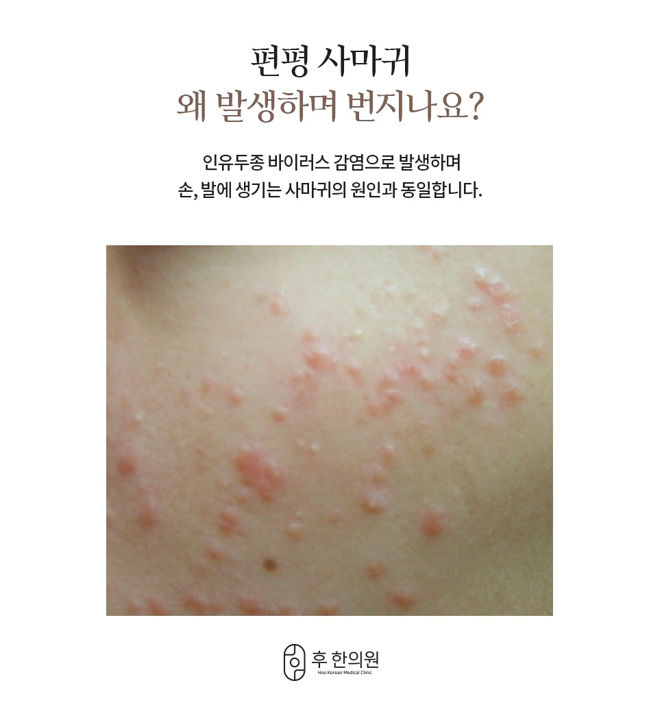 편평사마귀 원인 및 증상 피부 사진
