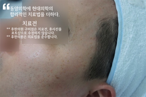 편평사마귀 한방 치료 전 피부 상태