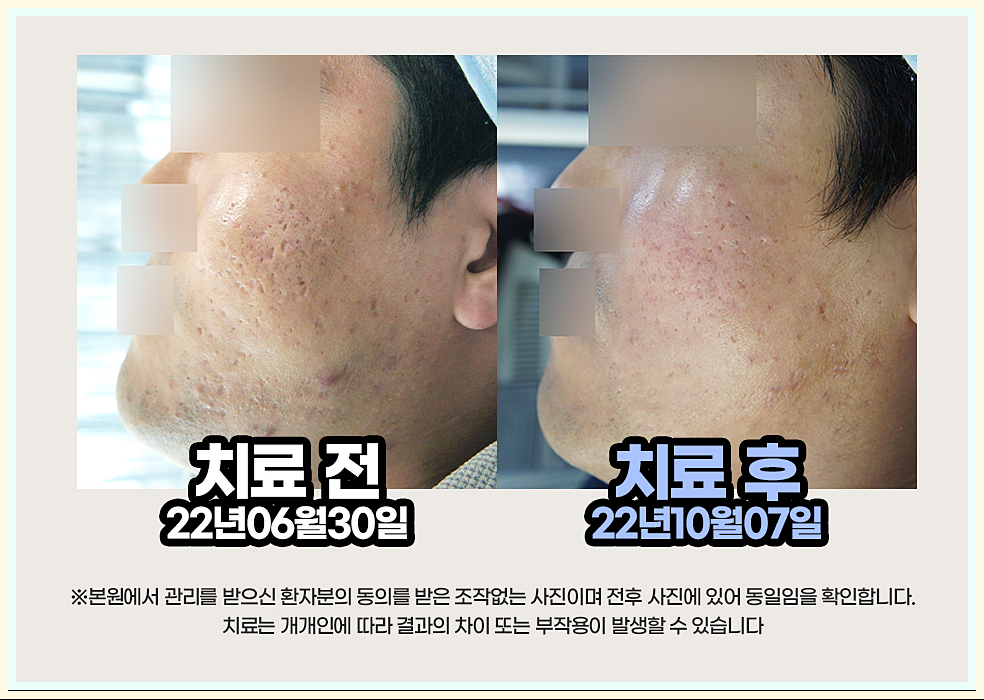 구미여드름흉터 치료 전후 이미지