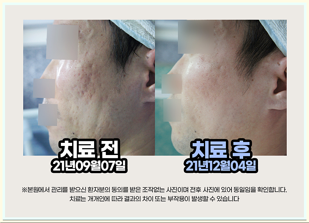 구미여드름흉터 실제 환자 볼 여드름흉터 치료 전후 비교