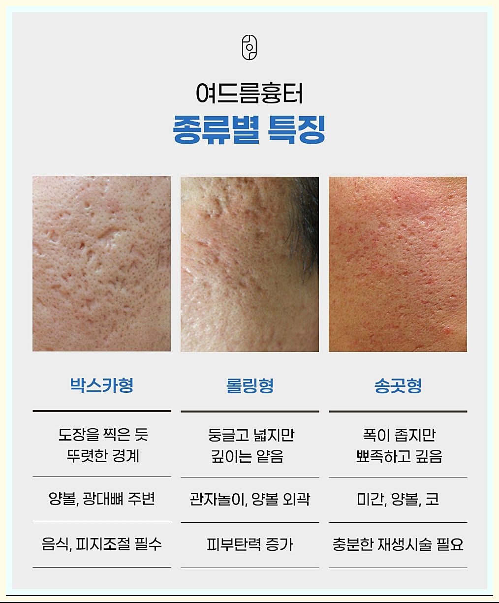 여드름흉터의 종류별 특성을 정리한 이미지