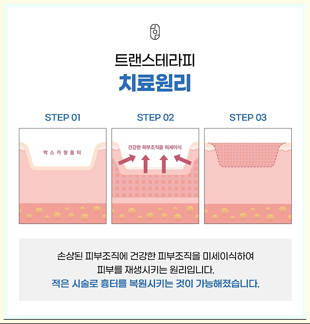 구미여드름흉터 트랜스테라피 치료의 원인에 대해