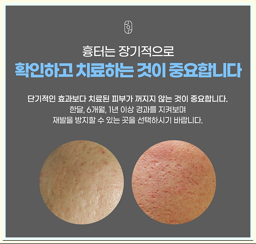 장기적으로 진행해야 하는 흉터 치료의 중요성