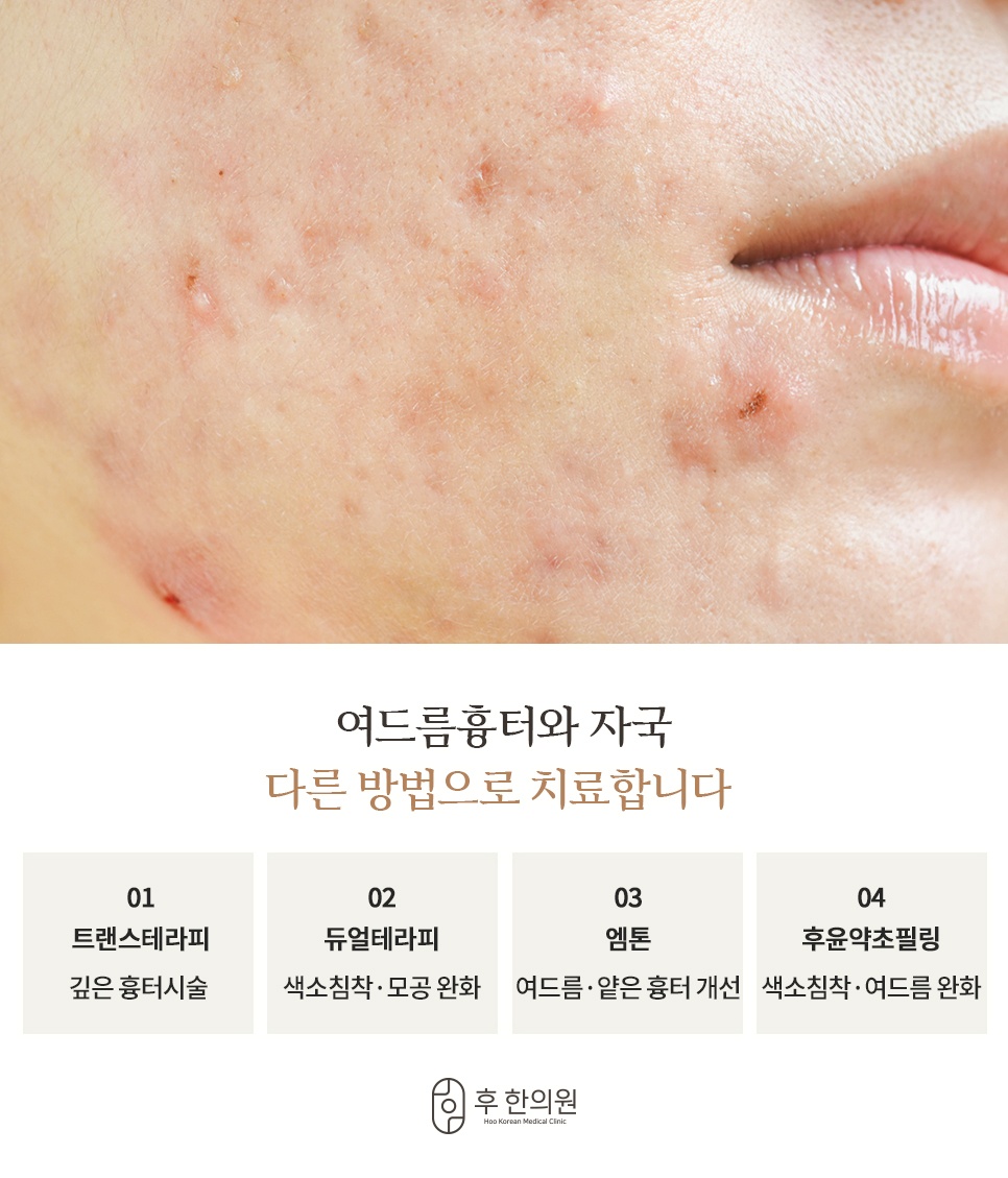 여드름흉터와 자국 종류별 맞춤 치료법 (트랜스테라피, 듀얼테라피, 엠톤, 후윤약초필링)