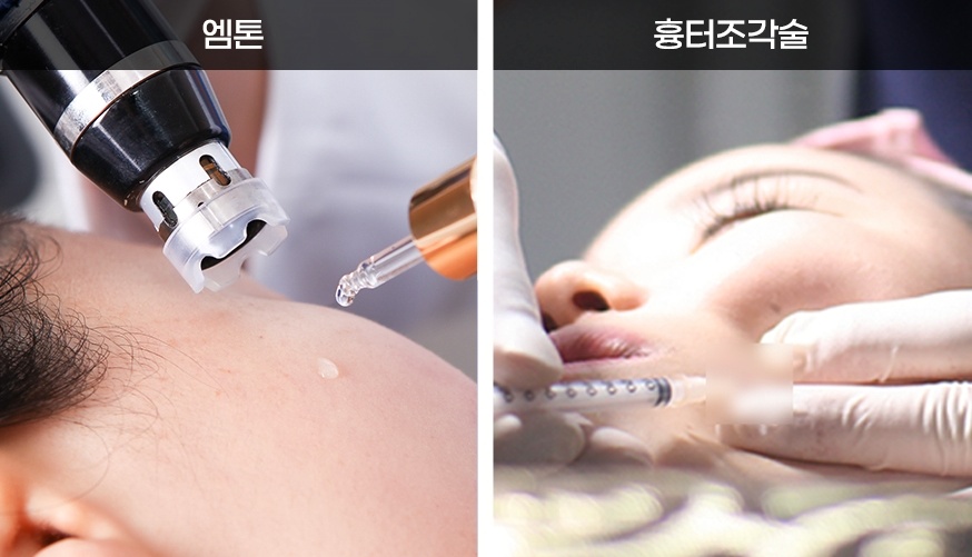 후한의원 엠톤 시술 및 흉터조각술 여드름흉터 치료 과정