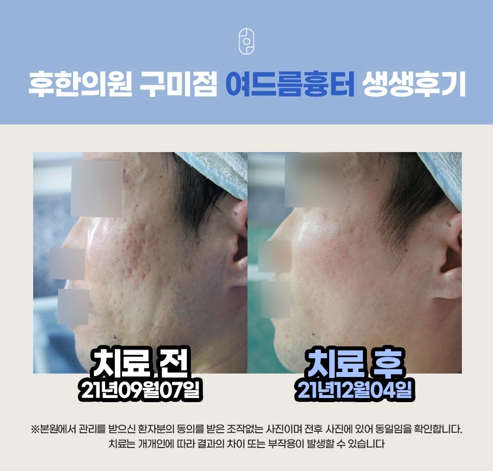후한의원 구미점 여드름흉터 치료 전후 비교 사진