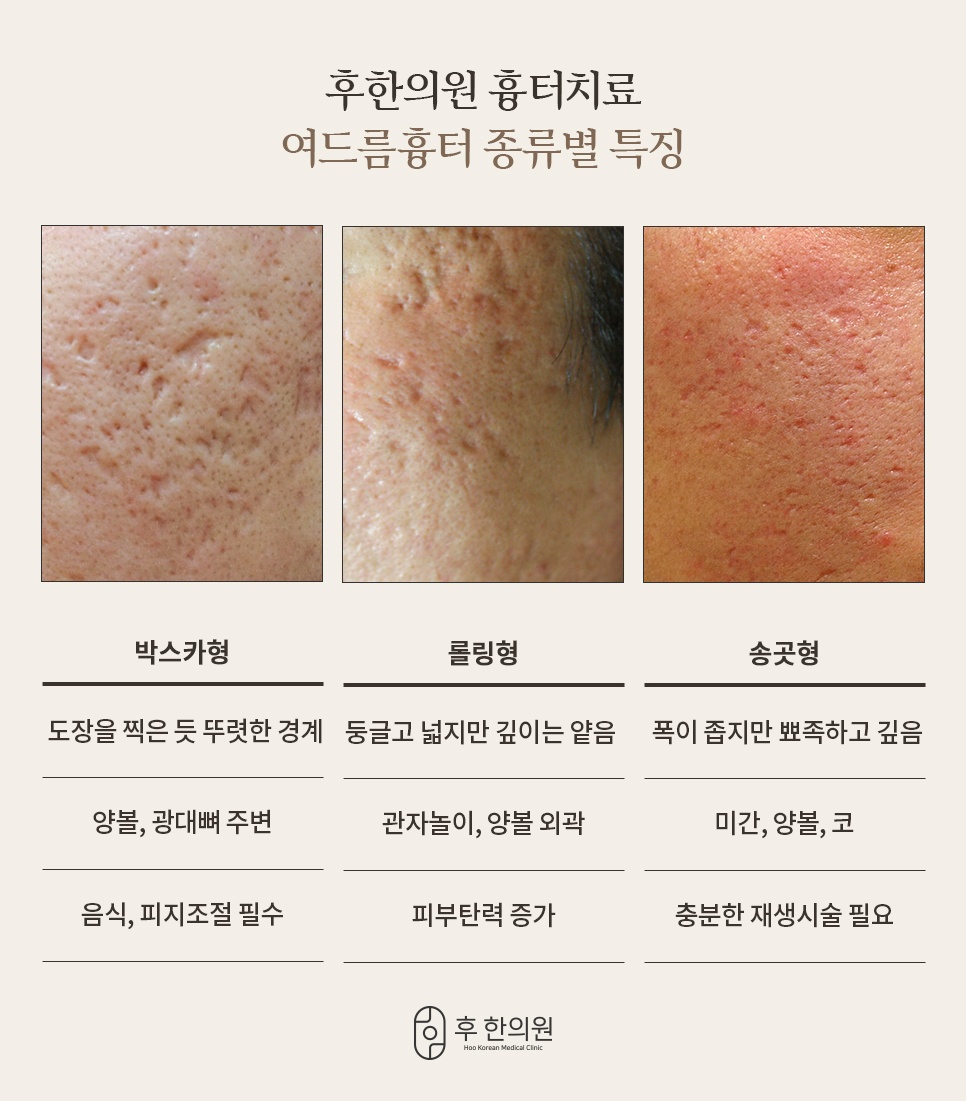 여드름흉터 종류별 특징 비교 (박스카형, 롤링형, 송곳형 흉터)