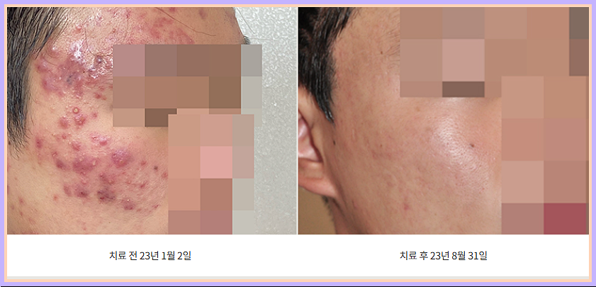 구미인동여드름 전후
