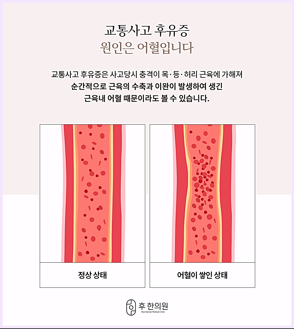 교통사고 후유증의 원인으로 보는 어혈, 정상 상태와 어혈이 쌓인 상태