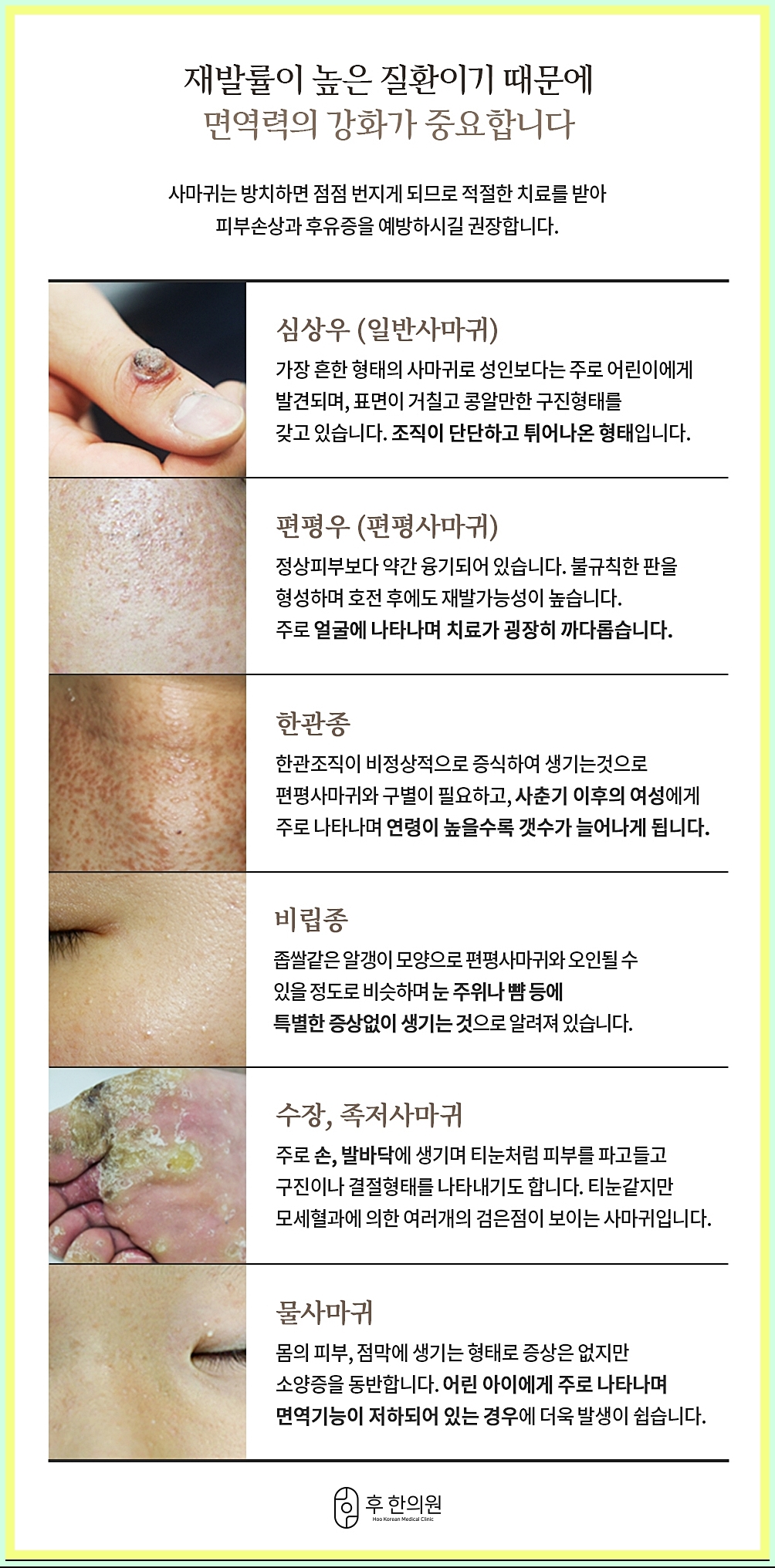 구미사마귀제거 사마귀의 종류 이미지