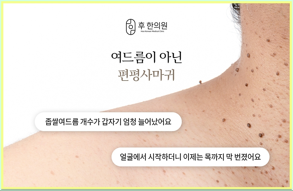 편평사마귀 메인 이미지