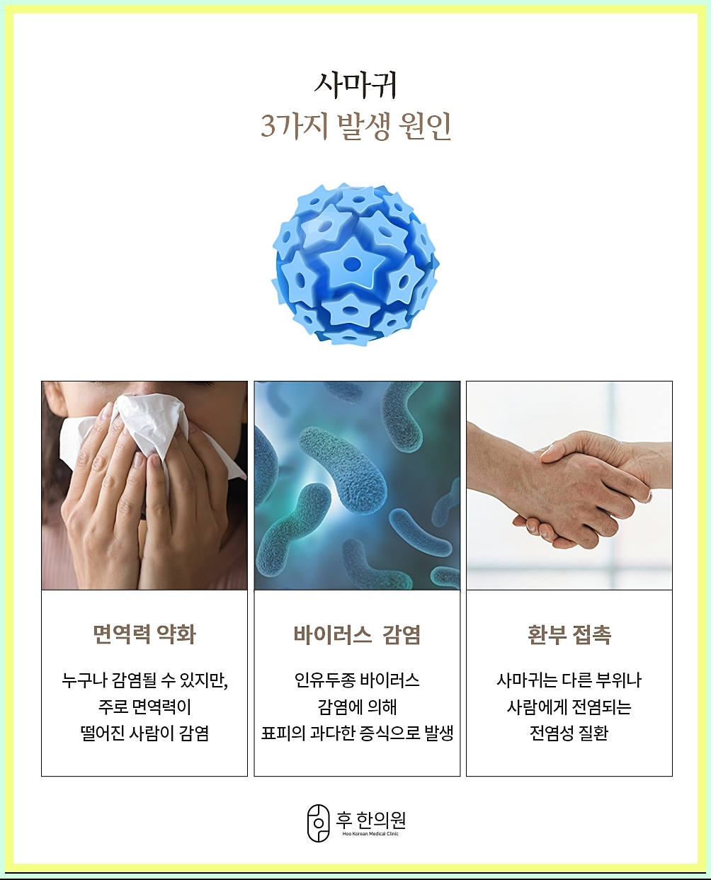 사마귀의 발생 원인 세 가지