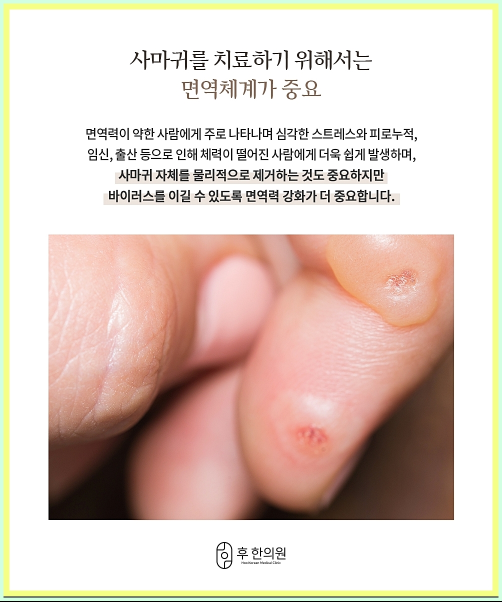구미사마귀제거 치료 시 중요한 면역력