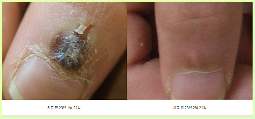 손가락에 생긴 사마귀 치료 전후