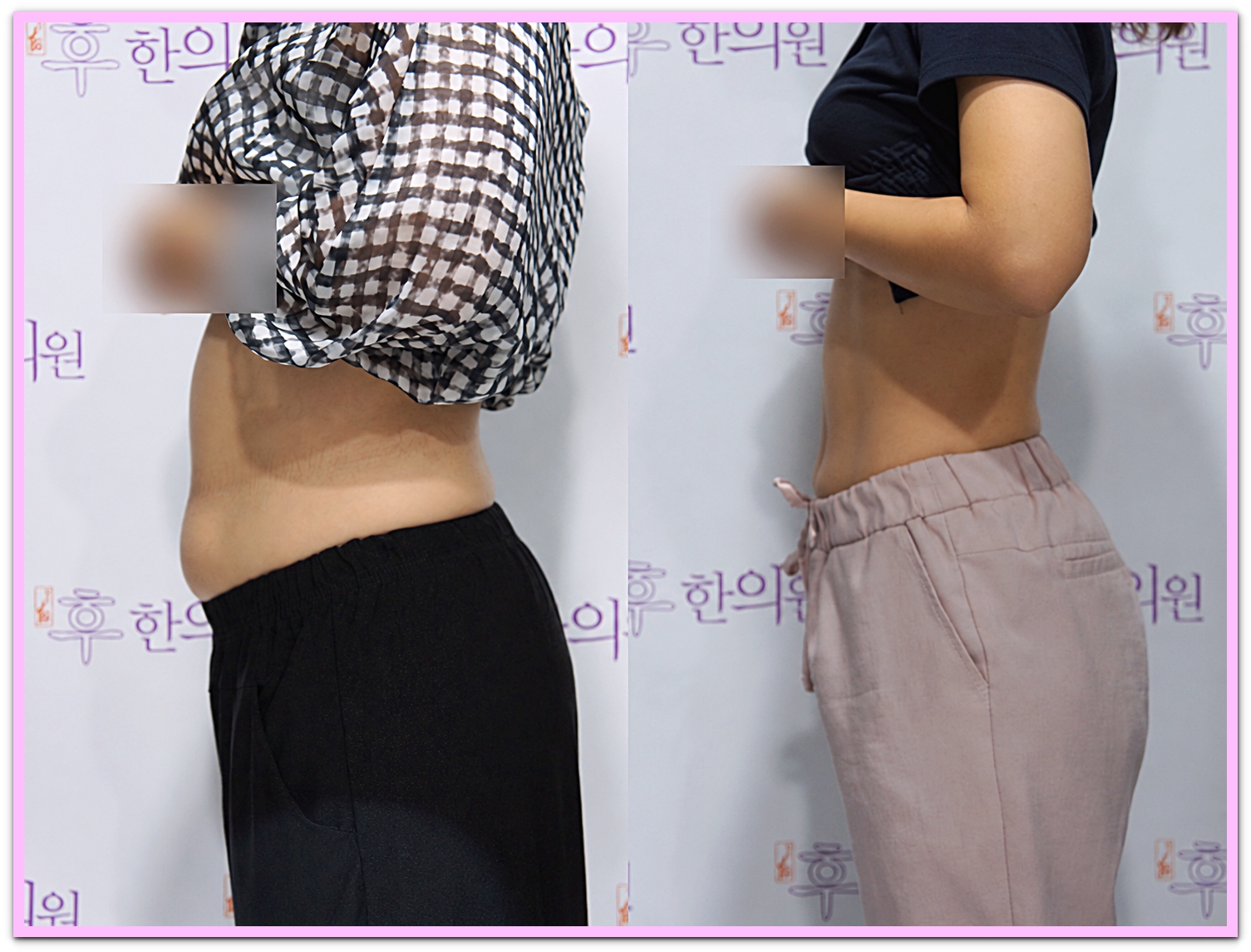 구미한방다이어트 3개월 옆모습 전후 비교 사진