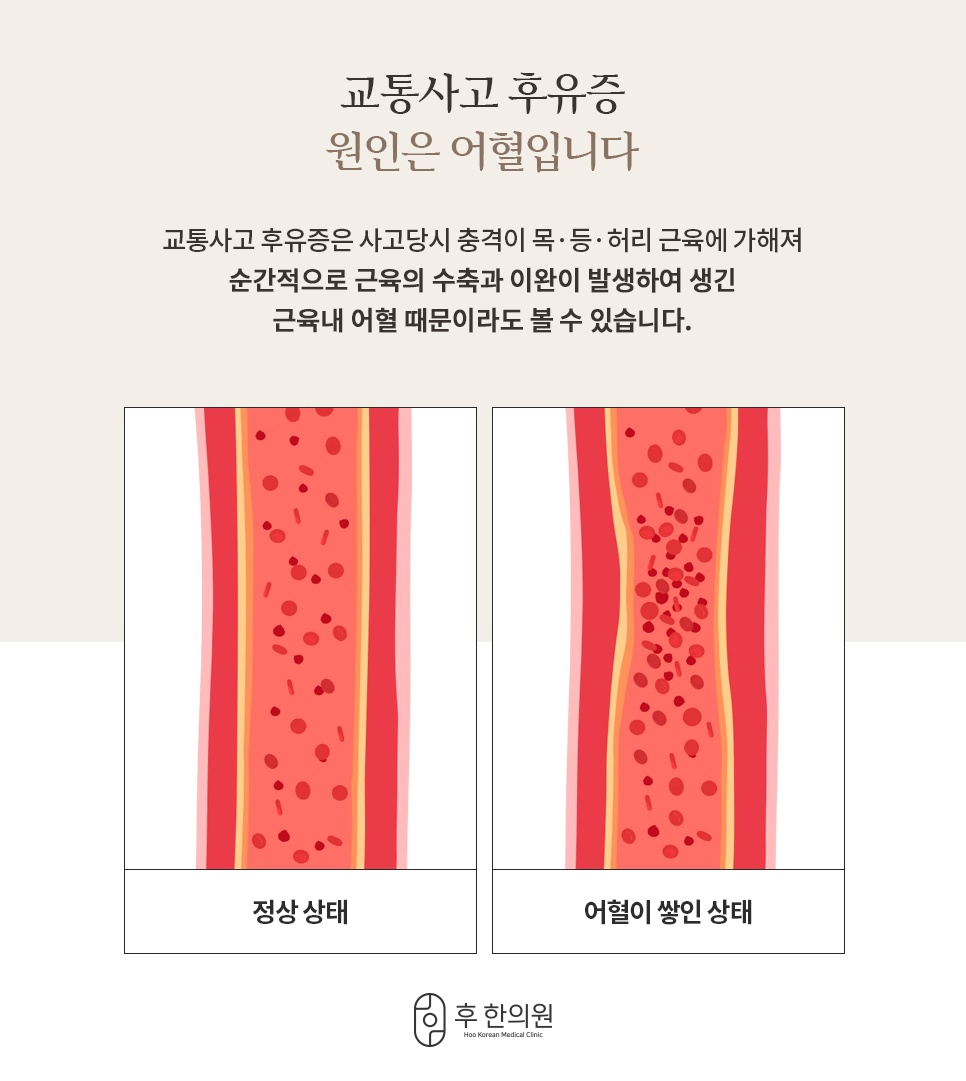 정상 혈관과 어혈이 쌓인 혈관을 나란히 비교한 후유증 원인