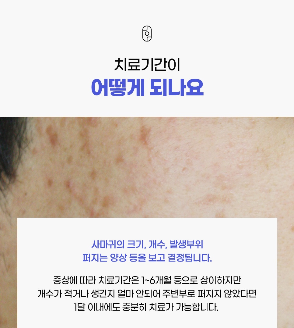 크기·개수·발생부위에 따라 1~6개월로 달라지는 편평사마귀 치료기간 안내
