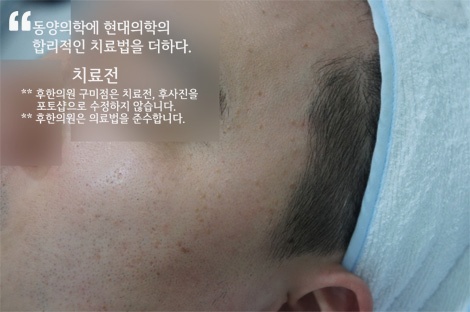 구미 편평사마귀 치료 전