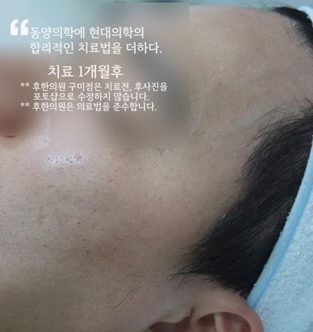 구미 편평사마귀 치료 후