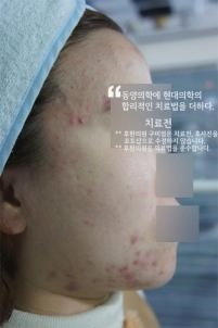 구미 여드름 치료 전