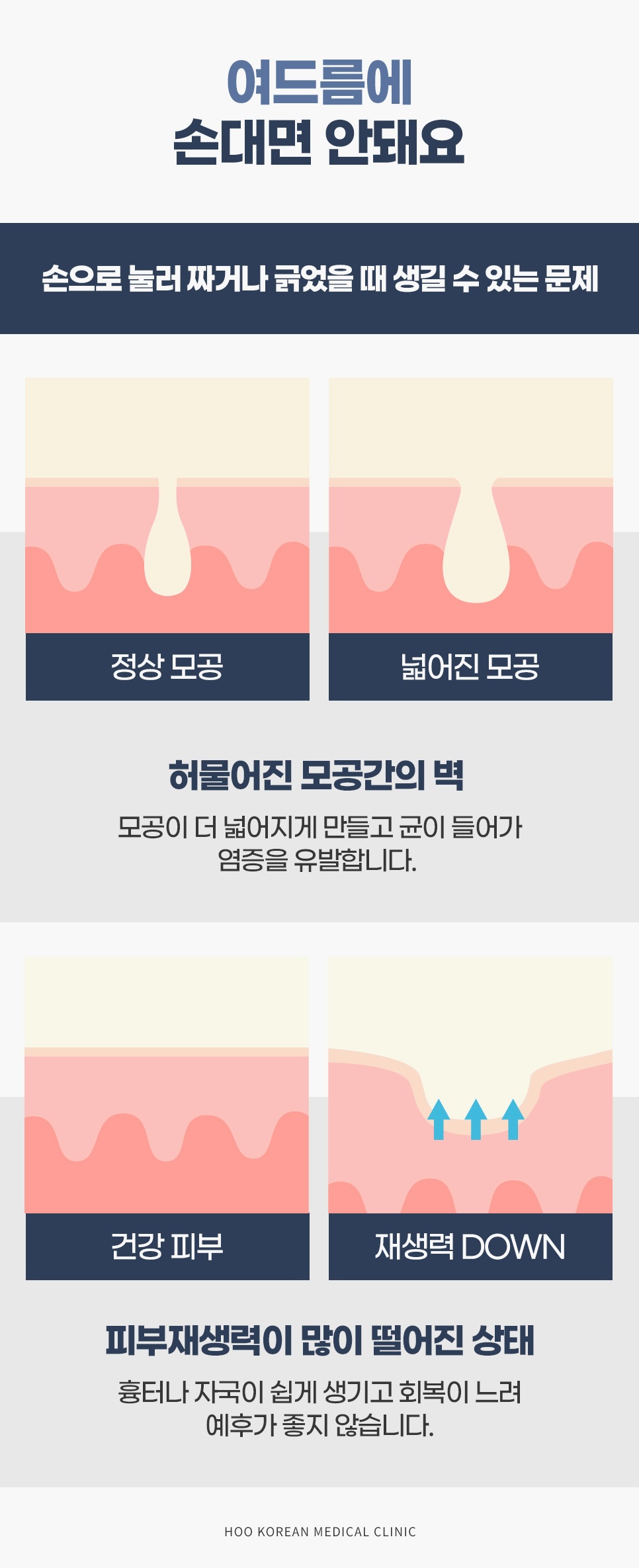 손으로 짜거나 긁었을 때 모공 벽이 허물어지고 재생력이 떨어지는 과정을 정상 피부와 비교한 단면도