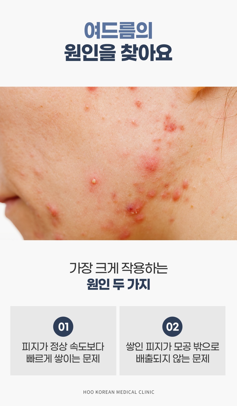 피지가 정상보다 빨리 쌓이고 모공 밖으로 배출되지 않는 여드름의 대표 원인 두 가지