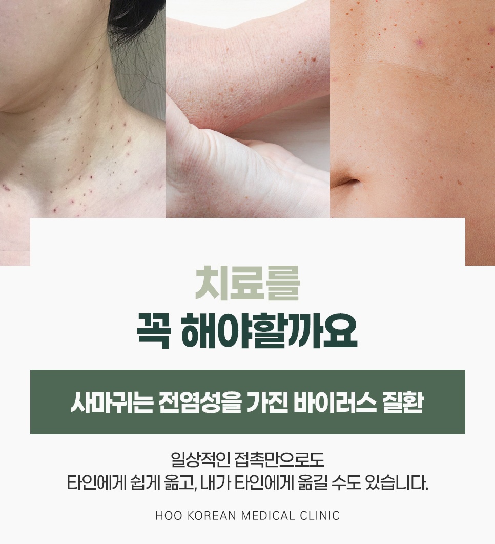 목과 쇄골, 팔, 배에 퍼진 점들로 일상 접촉만으로 타인에게 옮길 수 있는 전염성 바이러스 질환이라 치료가 필요한 이유
