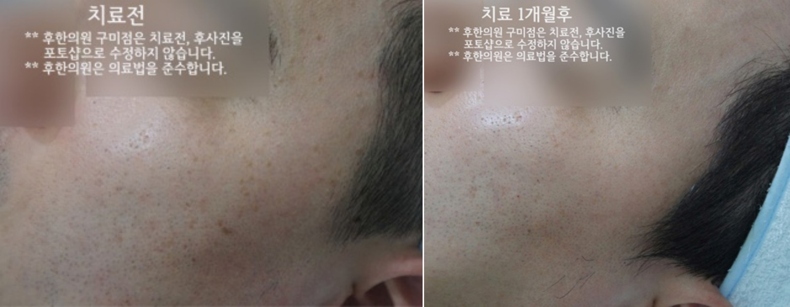 편평사마귀 치료 1개월 전후