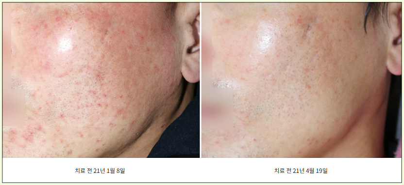 구미안면홍조 치료 전후